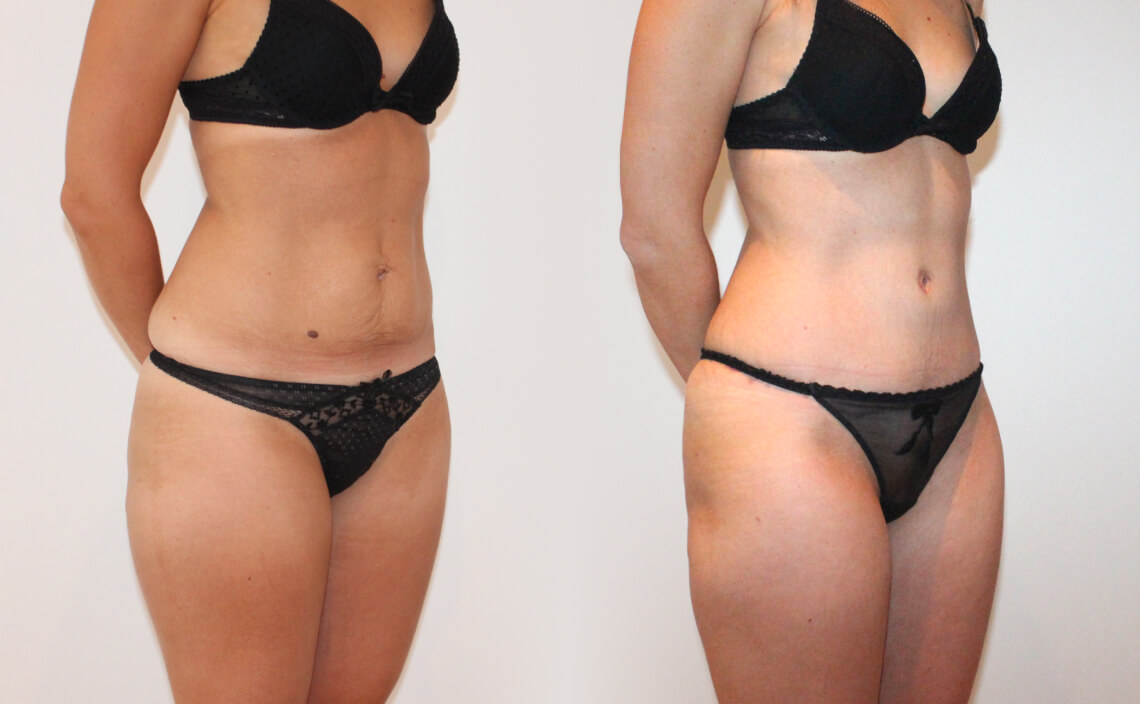 Abdominoplasty 1 - 1