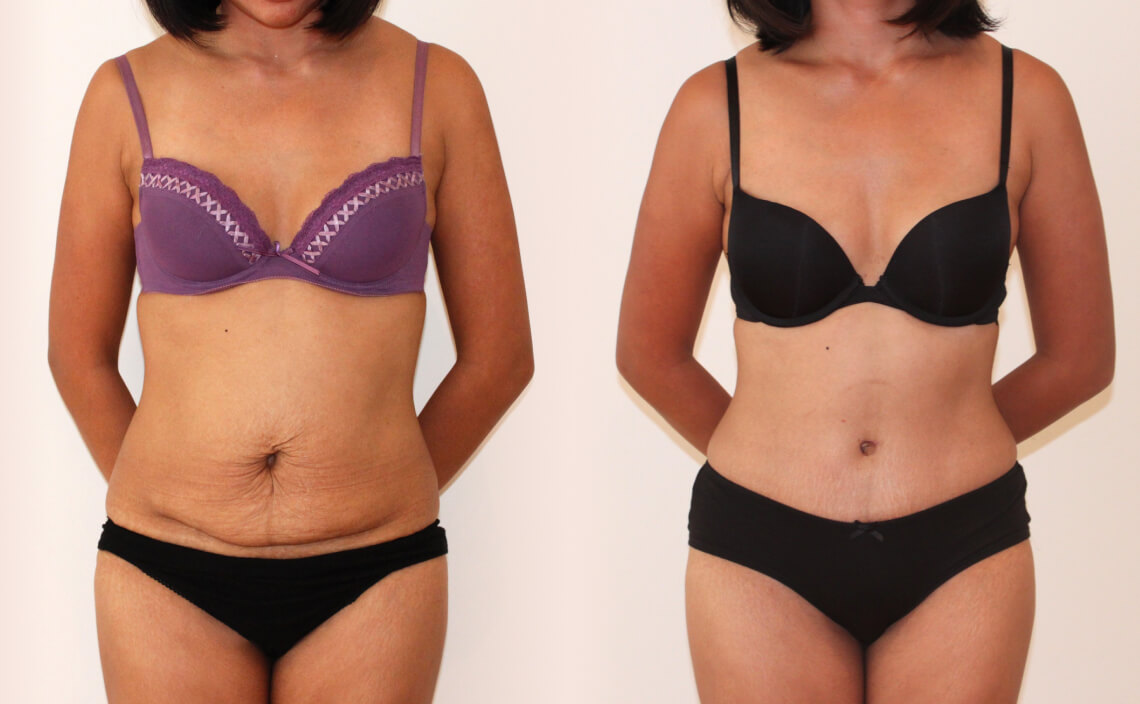 Abdominoplasty 1 - 3