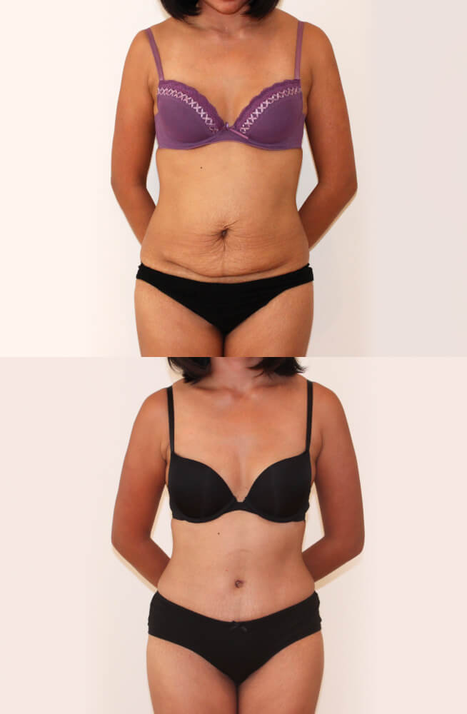 Abdominoplasty 1 - 4