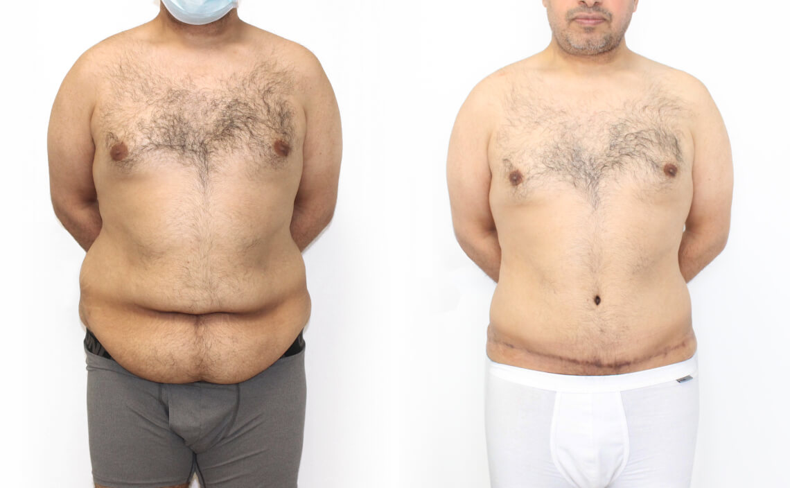 Abdominoplasty 1 - 5