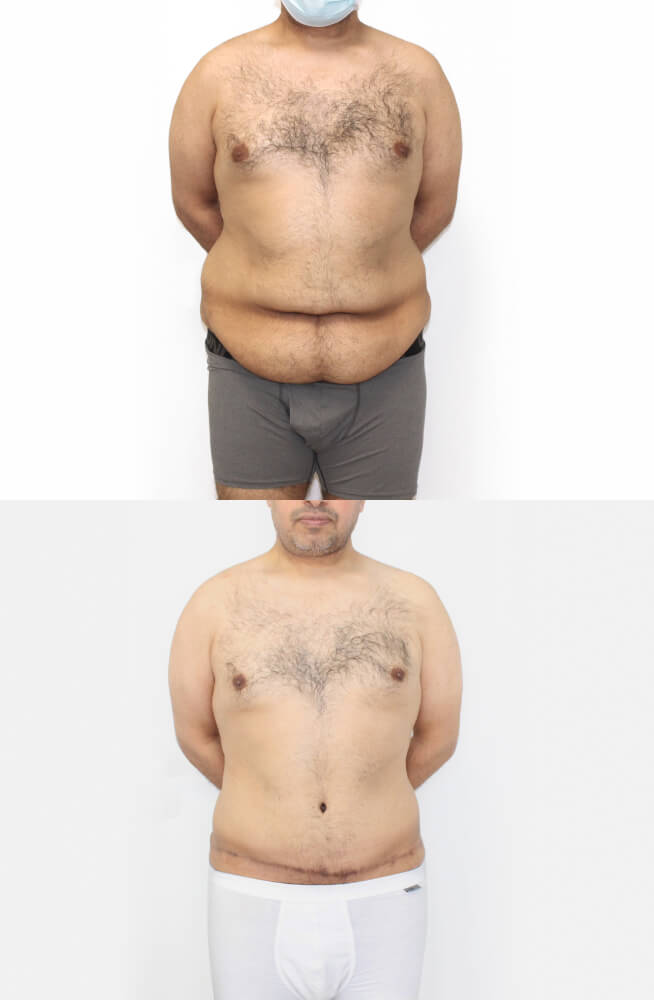 Abdominoplasty 1 - 6
