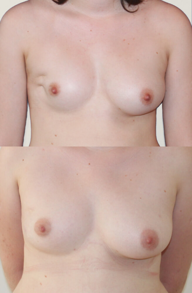 Breast Lipofilling-1