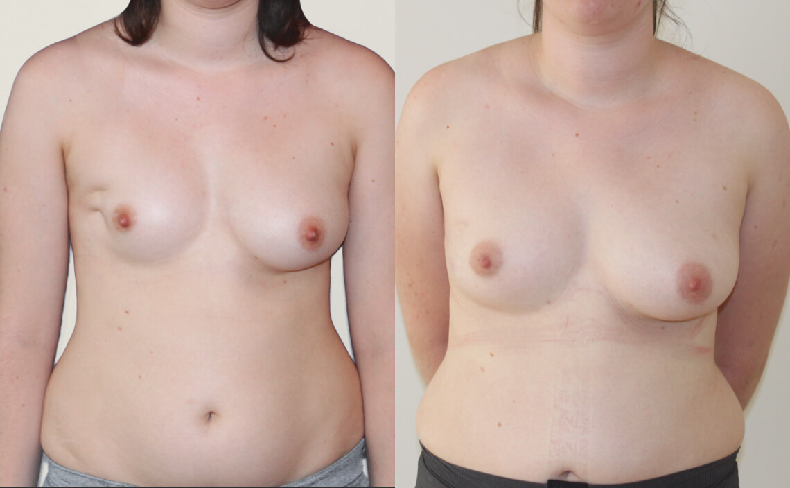Breast Lipofilling